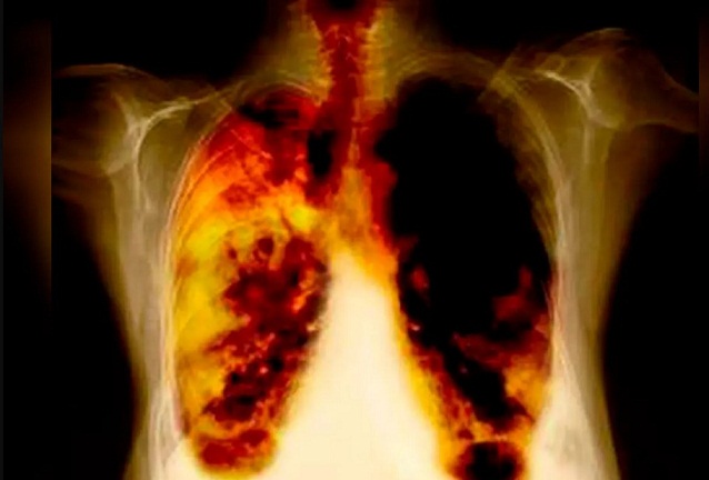 Cáncer Pulmón